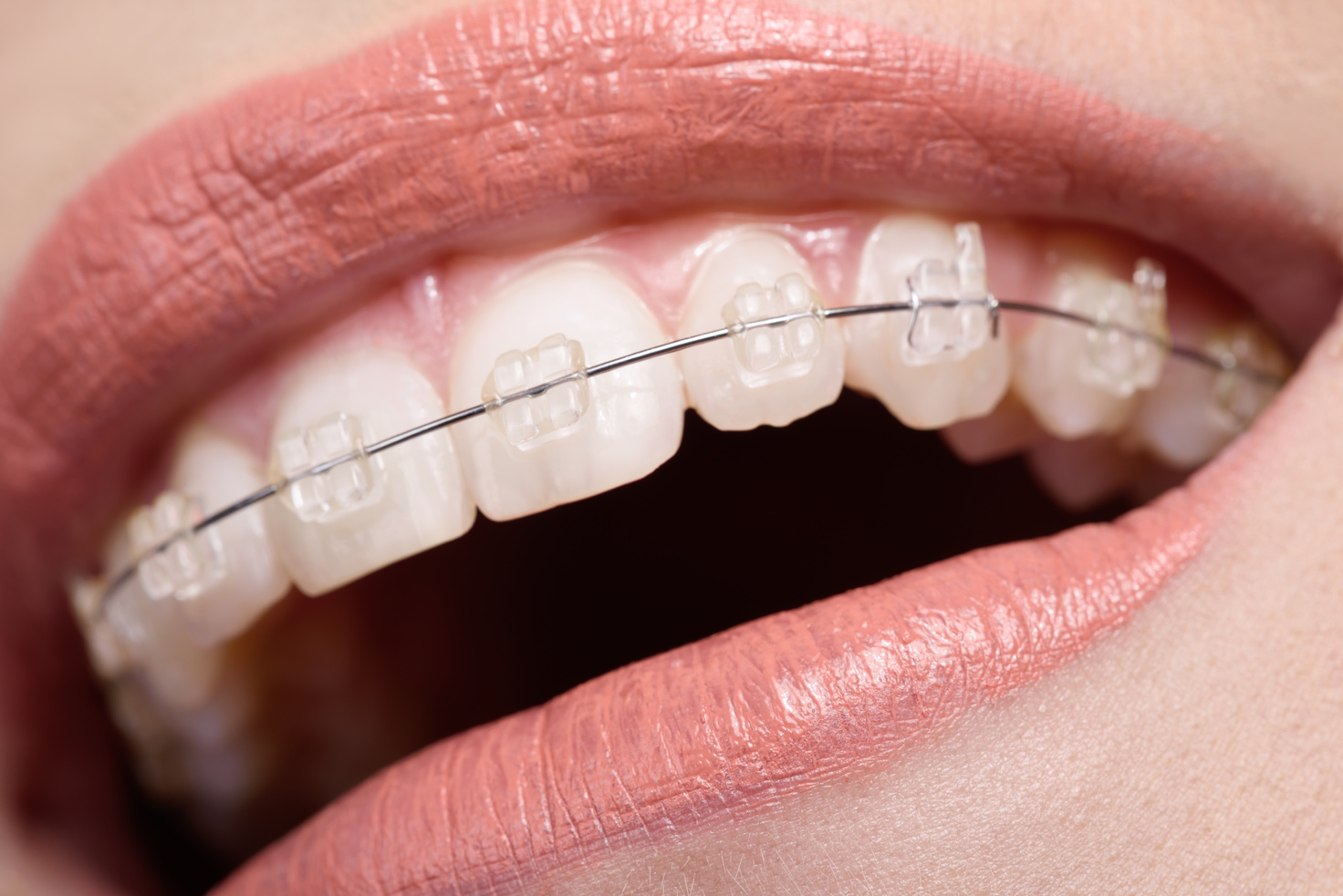 Best Dental Clinic in Coimbatore for Teeth Clip Treatment