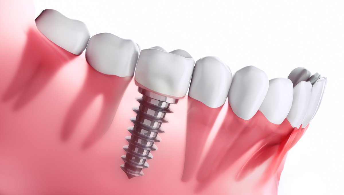Teeth Implants Dental Clinic Coimbatore