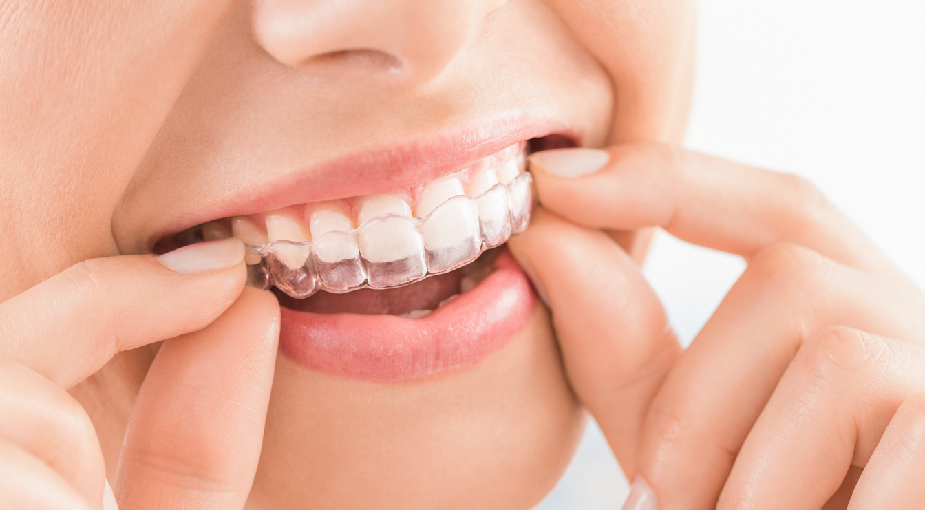 Best Dental Clinic in Coimbatore for Invisalign Treatment